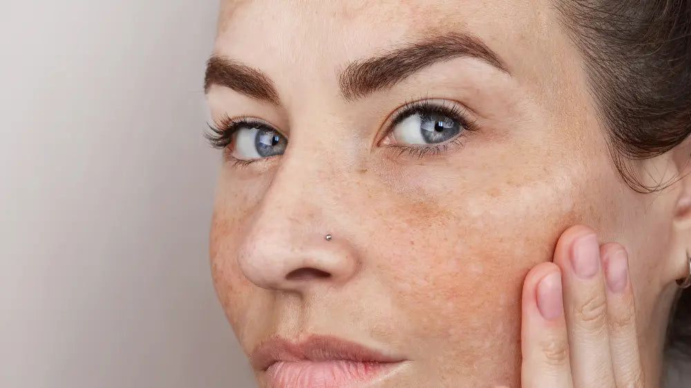 Rostro de mujer con manchas faciales o melasma en tratamiento con ácido glicólico