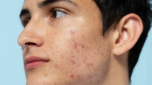 6 pasos para prevenir y tratar las manchas en la piel
